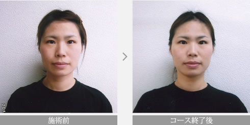 松山の整体 岡本整体療院 根治型美容整体 小顔 頭蓋骨矯正コース 施術例 1